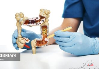 غربالگری سرطان روده بزرگ در جزیره کیش